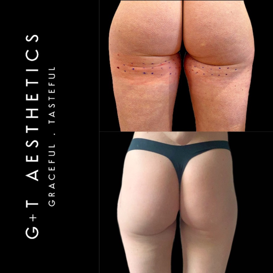 Before and After Fat Dissolving at G&T Aesthetics