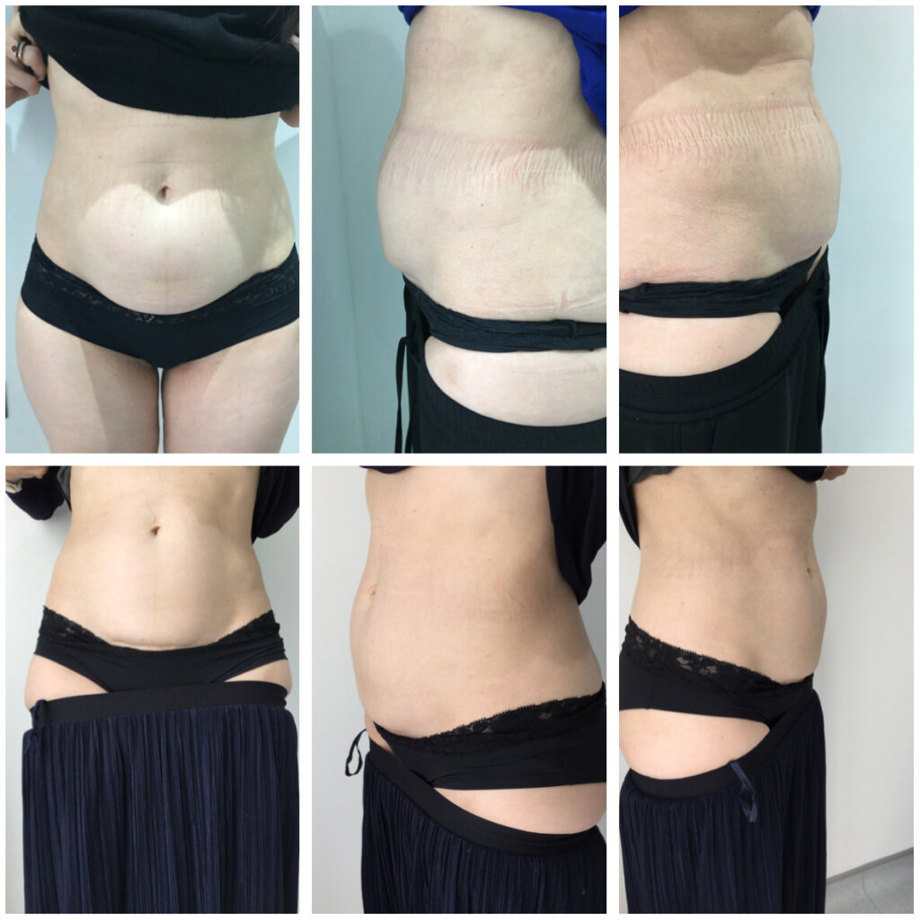 Before and After Belly Fat Dissolving at G&T Aesthetics