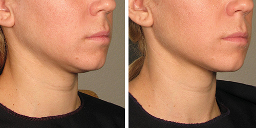 Before and After Fat Dissolving Chin at G&T Aesthetics